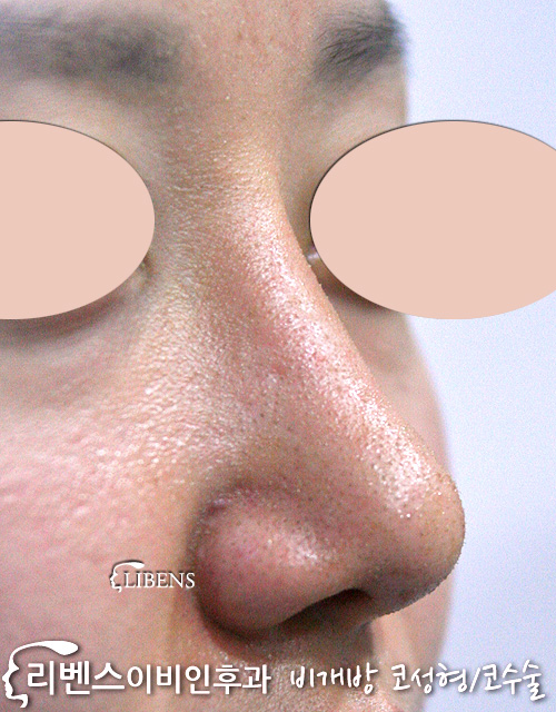 매부리코 메부리코 수술 콧대 비중격 교정 코끝 연골묶기 성형 s115